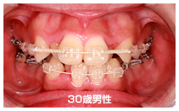 表側にワイヤー（ホワイトワイヤー）を使用する装置