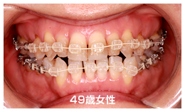 表側にワイヤー（ホワイトワイヤー）を使用する装置