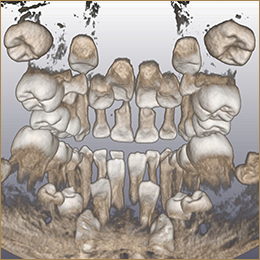 歯科用CTスキャナ