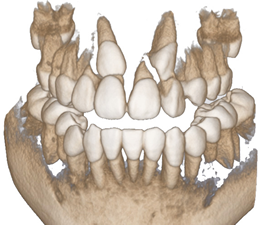 歯科用CTスキャナ