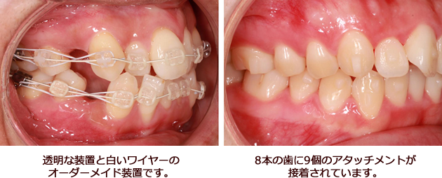 インビザライン装置の治療って何するの？
