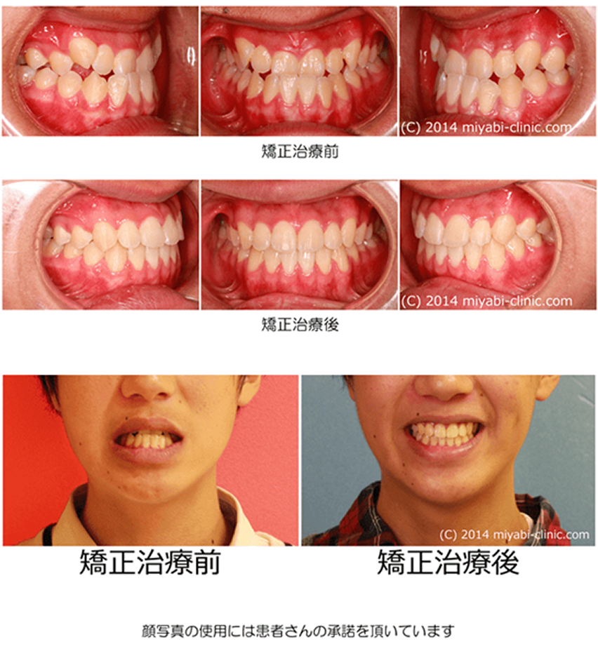 症例の一覧 - 気づかれない目立たない矯正／みやび矯正歯科医院