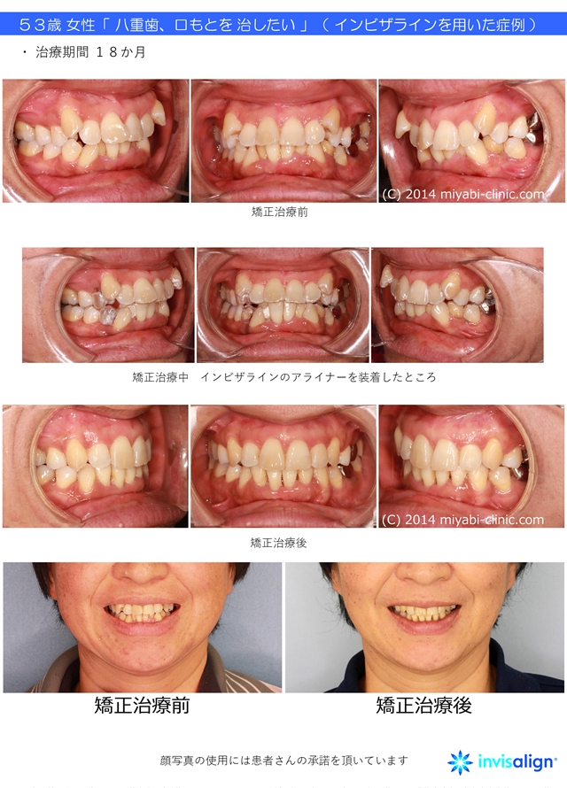 耐熱 二層 足あとぐらす (M) Pbm歯列矯正装置マウスピースinvisalignインビザライン歯科医チューイー