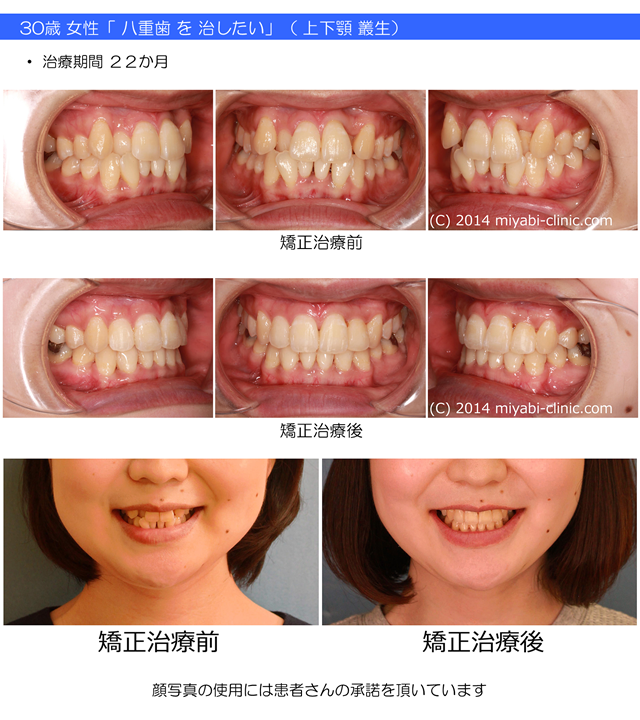 症例の一覧 - 気づかれない目立たない矯正／みやび矯正歯科医院 - 岡山