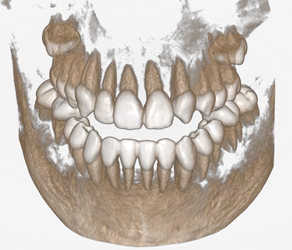 0177 CBCT