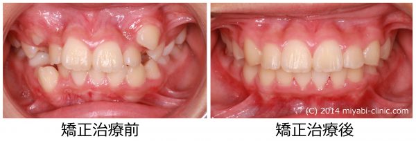 治療前後①正面