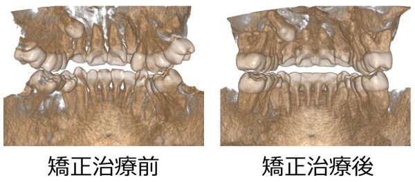 0179CBCT 初診 後ろ-3