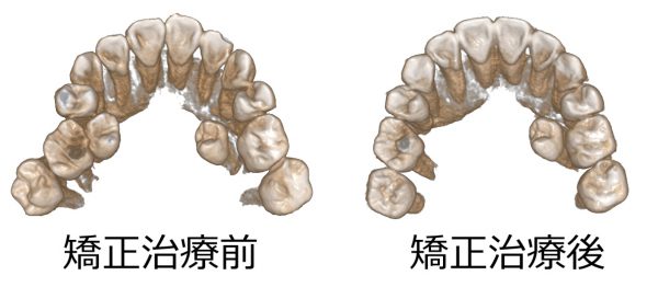 0179CBCT 初診終了時咬合面