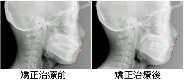 初診 終了時セファロ - コピー