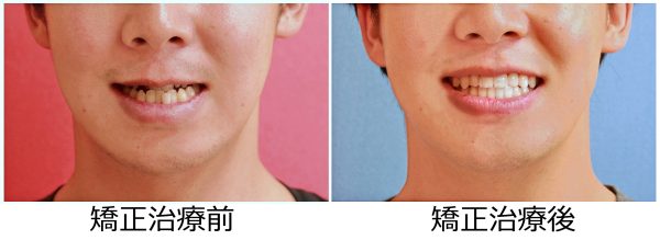 受け口 治療前後