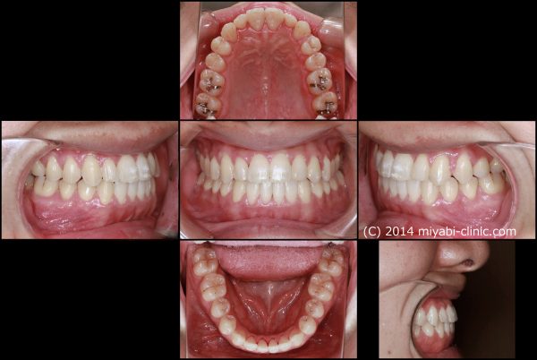 反対咬合 治療後