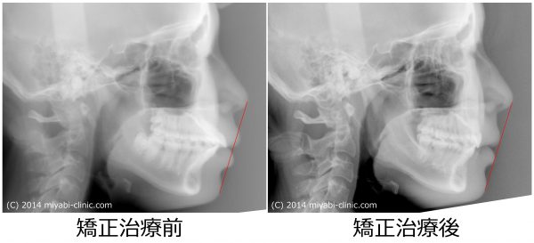 192_治療前後セファロ側面 - コピー