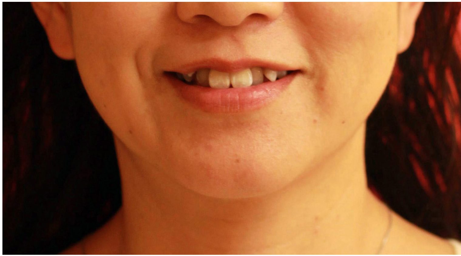 インビザラインによる治療 46歳 女性 「八重歯を治したい」 みやび矯正歯科医院