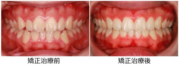 352 治療前 正面 - コピー