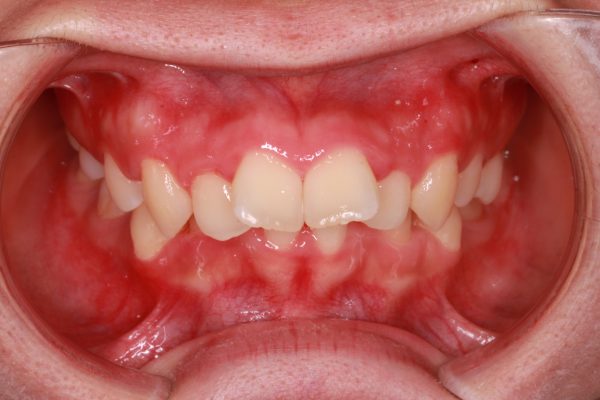 24歳 女性 出っ歯 を治したい 重度の上顎前突症 みやび矯正歯科医院