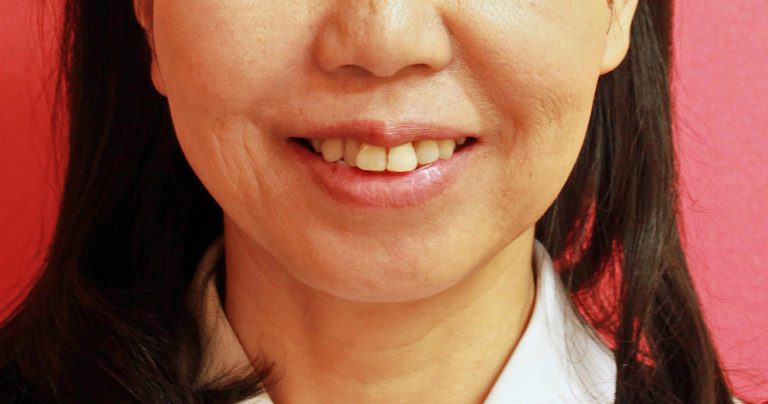 インビザラインによる治療 57歳 女性「前歯のガチャガチャ を治したい」 みやび矯正歯科医院
