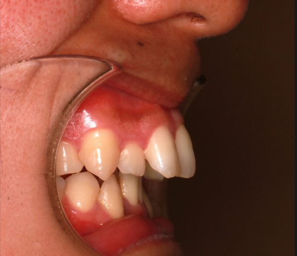 26歳 男性 出っ歯 を治したい 上顎前突症 みやび矯正歯科医院