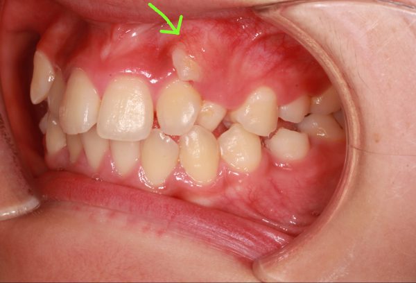 歯茎 に 歯 が 生える 大人