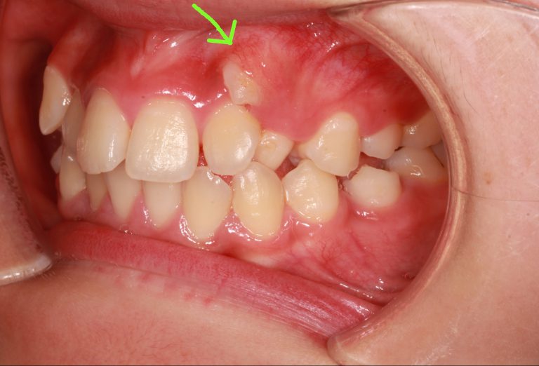 14歳 女性 「歯ぐき から 歯が出てきた」（ 埋伏歯 ・叢生） みやび矯正歯科医院