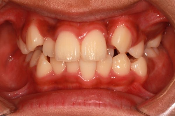 12歳 男性 八重歯 ガチャガチャ を治したい 抜歯症例 みやび矯正歯科医院