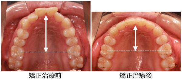 口ゴボの原因