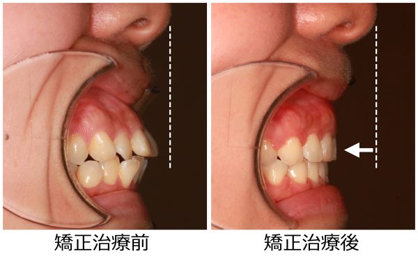 口ゴボ 治療前後