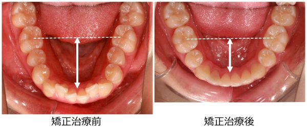 口ゴボ治療前後