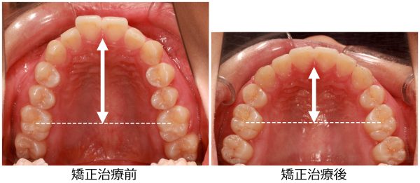 口ゴボ治療前後