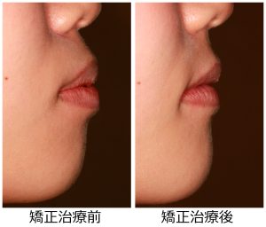 口ゴボ治療前後