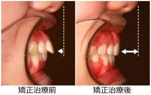 口ゴボ治療前後