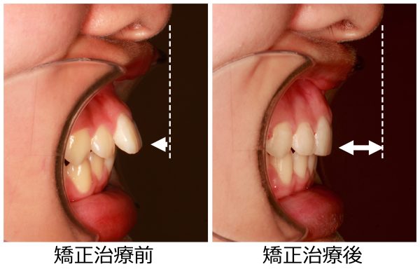 口ゴボ治療前後