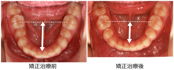 口ゴボ治療前後