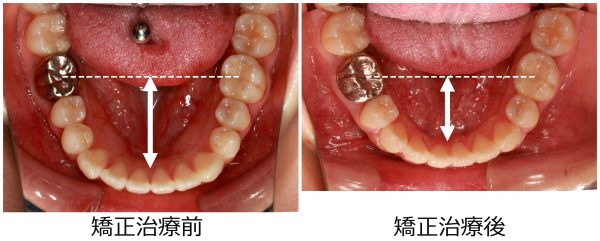 口ゴボ治療前後