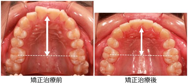 口ゴボ治療前後