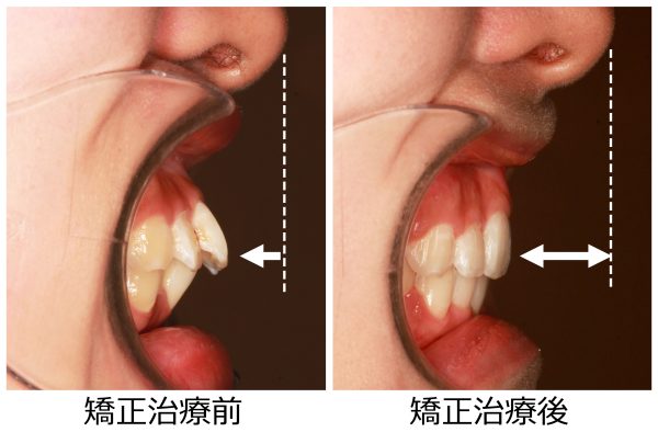 出っ歯治療前後