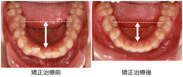 口ゴボ治療前後