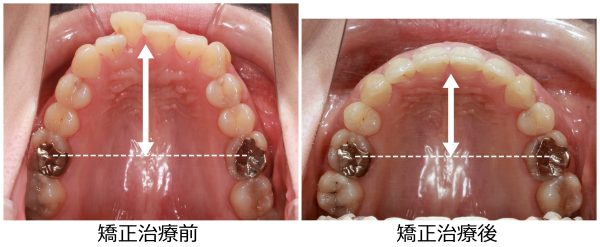 口ゴボ治療前後