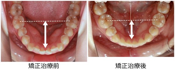 口ゴボ治療前後