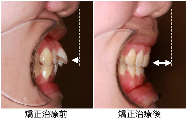 口ゴボ治療前後