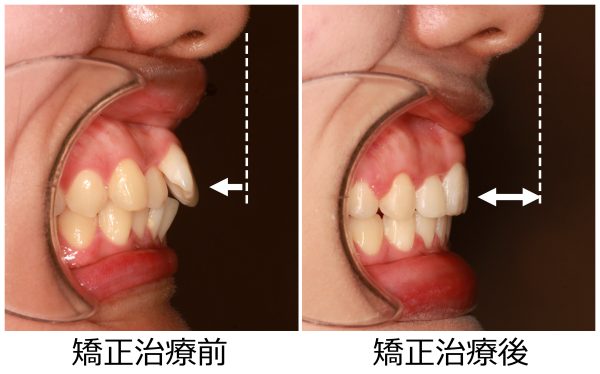 口ゴボ治療前後