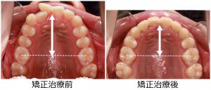 口ゴボ治療前後