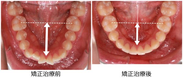 口ゴボ治療前後