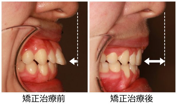 出っ歯治療前後