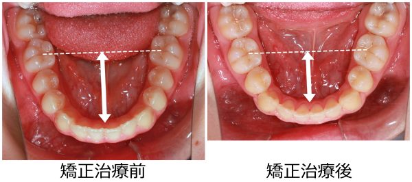 口ゴボ治療中