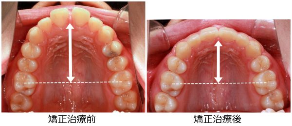 口ゴボ治療前後