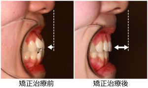 口ゴボ治療前後