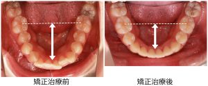 口ゴボ治療前後