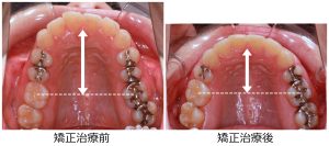 口ゴボ治療前後