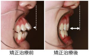 口ゴボ治療前後