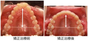 出っ歯治療前後